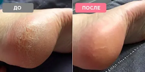 Електрична пемза-пилка для ніг Pedi Vac Прилад для видалення мозолів з вакуумним пилососом акумулятор USB