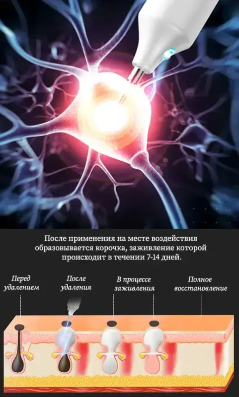 Коагулятор плазмовий, Plasma Pen/Електрокоагулятор/Бездротова ручка для видалення папілом та бородавок